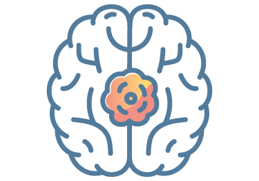 Brain illustration with Glioma